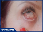 Отек глаза и ожог роговицы: таганроженка пожаловалась на болезненные симптомы после  наращивания ресниц