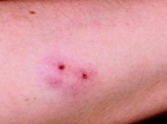 В Ростовской области люди подверглись массовым атакам кровососущим насекомых 