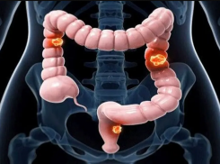Коварный и смертоносный: 5 мифов о раке толстой кишки - их опровергли таганрогские врачи