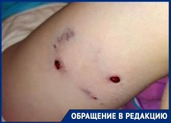 "Травмированная психика и шрам на всю жизнь": в Таганроге на ребёнка напала бродячая собака